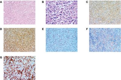 Sintilimab combined with anlotinib as first-line treatment for advanced sarcomatoid carcinoma of head and neck: a case report and literature review